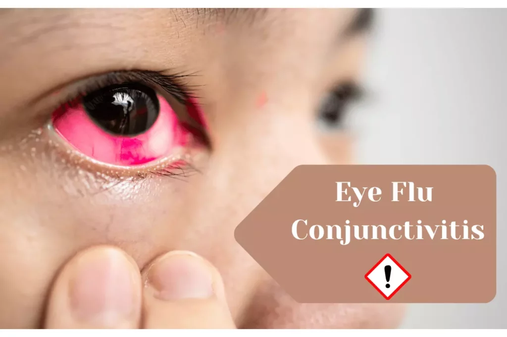 Eye Flu Conjunctivitis